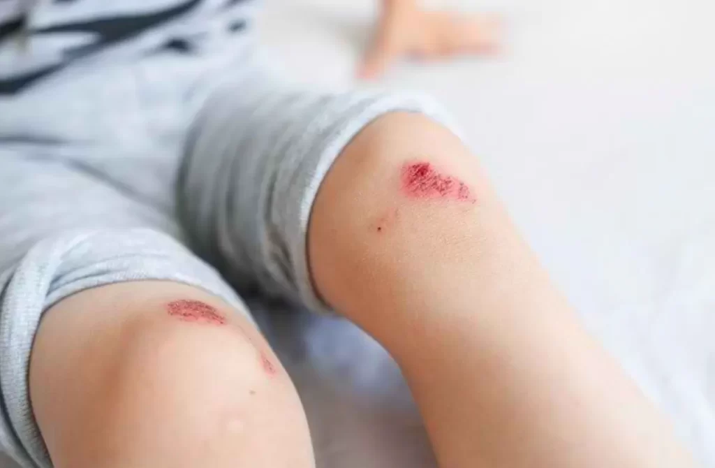 luka anak susah sembuh