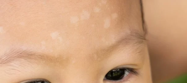Bercak putih pada kkulit tapi bukan panu