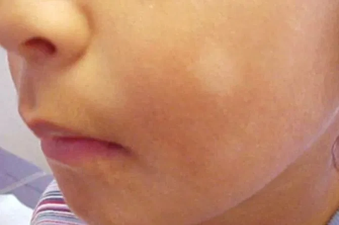 Jenis-jenis bercak putih