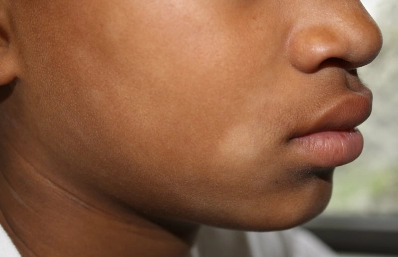 Penyebab bercak putih