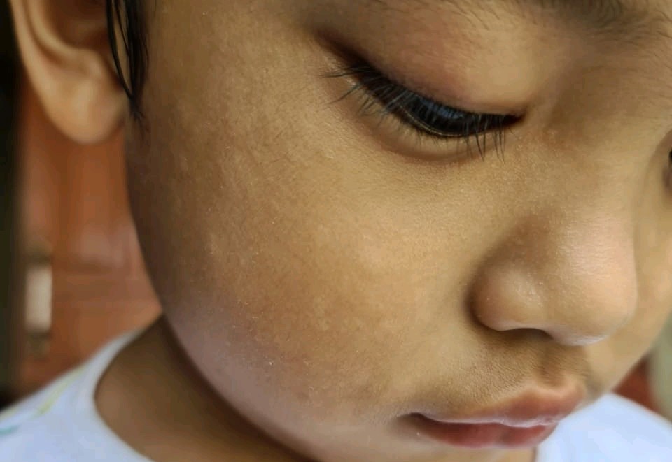 Perbedaan pityriasis alba dan panu