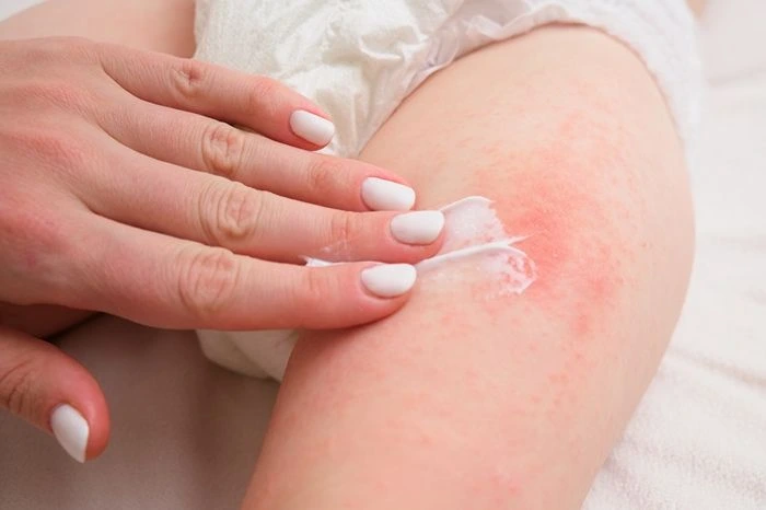 Cara mengatasi kulit sensitif