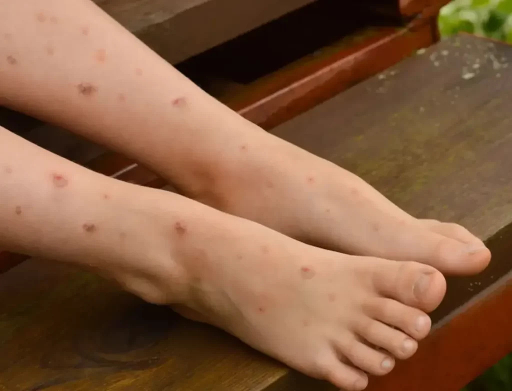 Dampak bekas luka dibiarkan