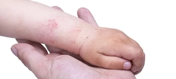 Dermatitis atopik