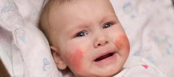 kenali ciri-ciri kulit sensitif