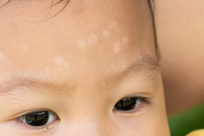 Penyebab bercak putih