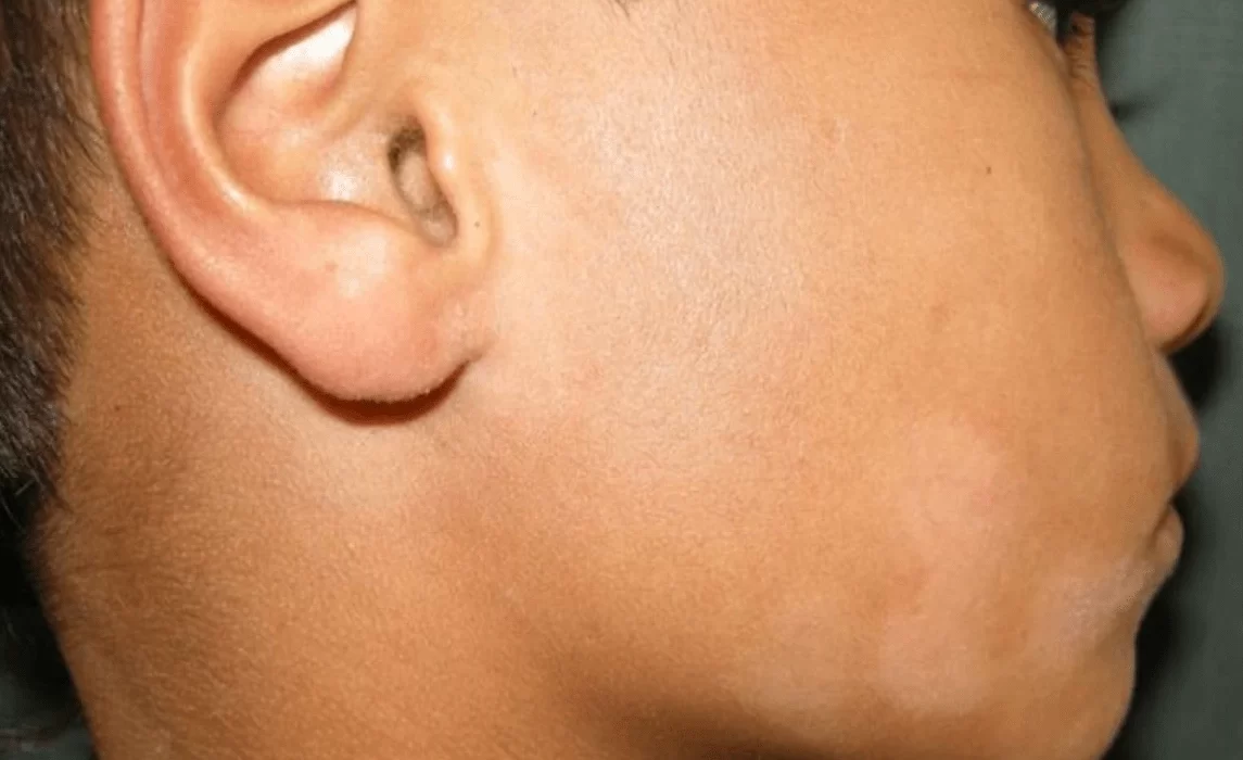 Bercak putih seperti panu tapi tidak galat