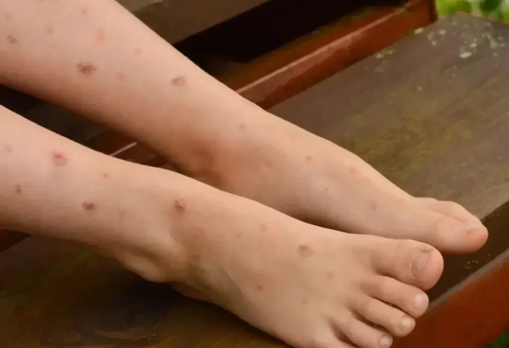 cara menghilangkan bekas luka di kaki