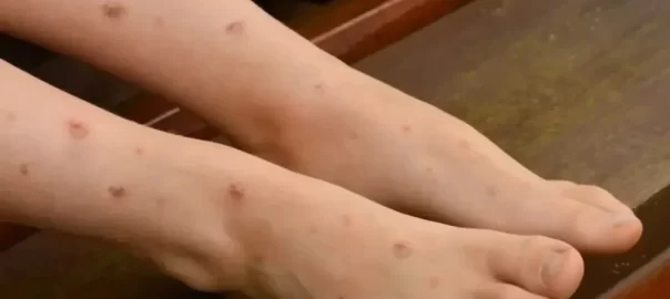 cara menghilangkan bekas luka di kaki